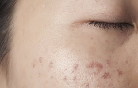 Pigmentation disorders