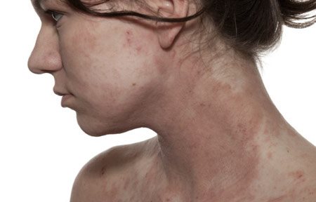 White skinned woman´s face and décolleté with Atopic Dermatitis