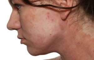 Atopic Dermatitis can lead to several physical as well as psychological issues, such as (amongst others) discrimination, stress and low self-confidence. Atopic Dermatitis on the face